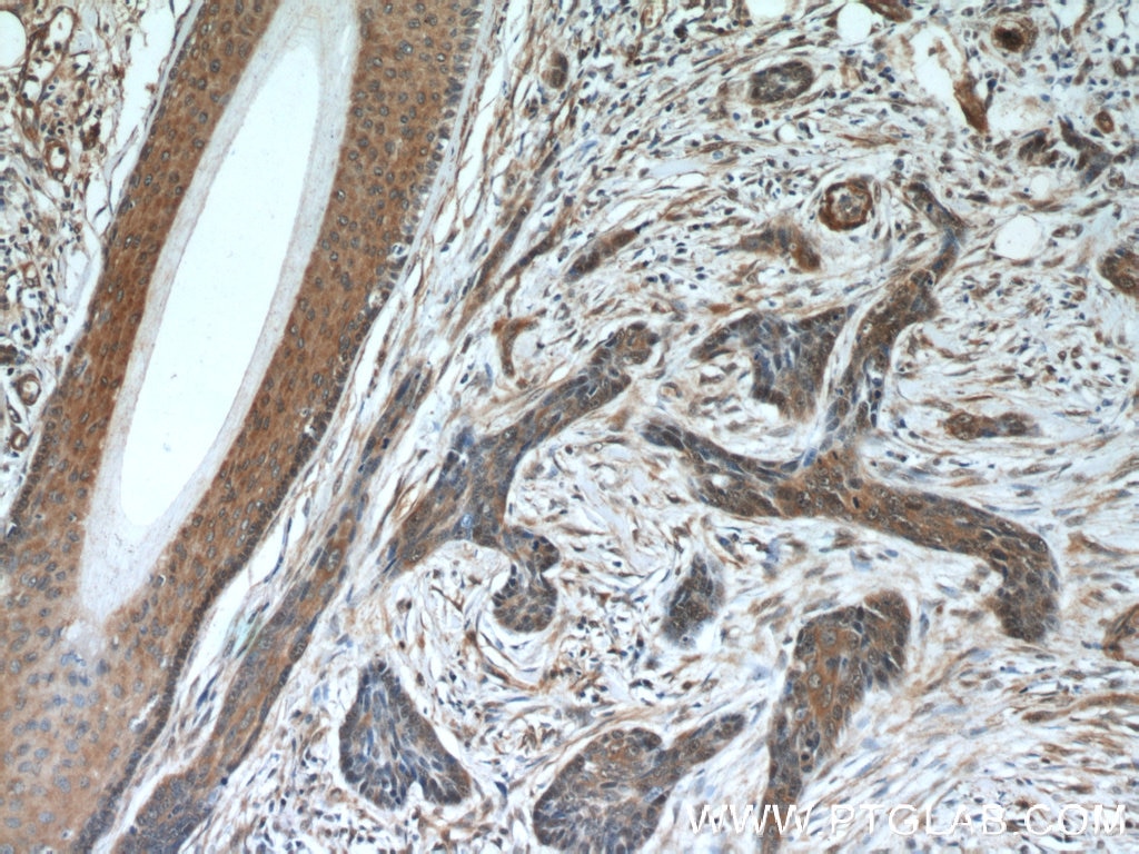 IHC staining of human skin cancer using 66099-1-Ig