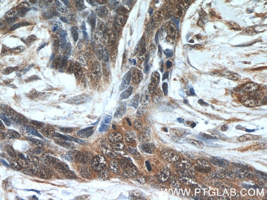 Immunohistochemistry (IHC) staining of human skin cancer tissue using EXOSC2 Monoclonal antibody (66099-1-Ig)