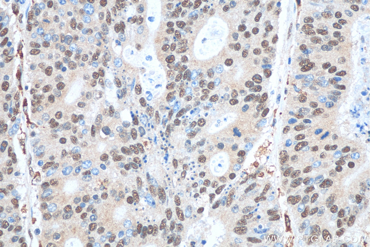 Immunohistochemistry (IHC) staining of human colon cancer tissue using EXOSC3 Polyclonal antibody (15062-1-AP)