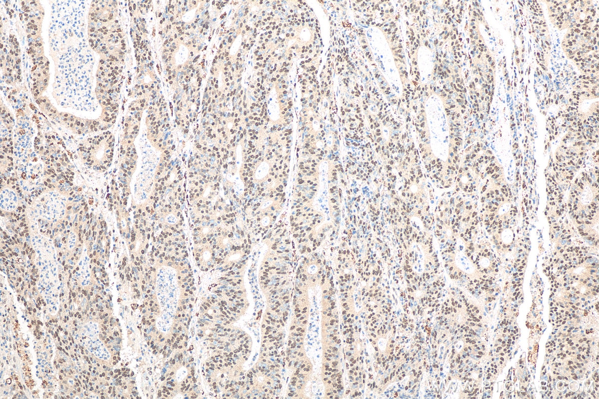 Immunohistochemistry (IHC) staining of human colon cancer tissue using EXOSC3 Polyclonal antibody (15062-1-AP)