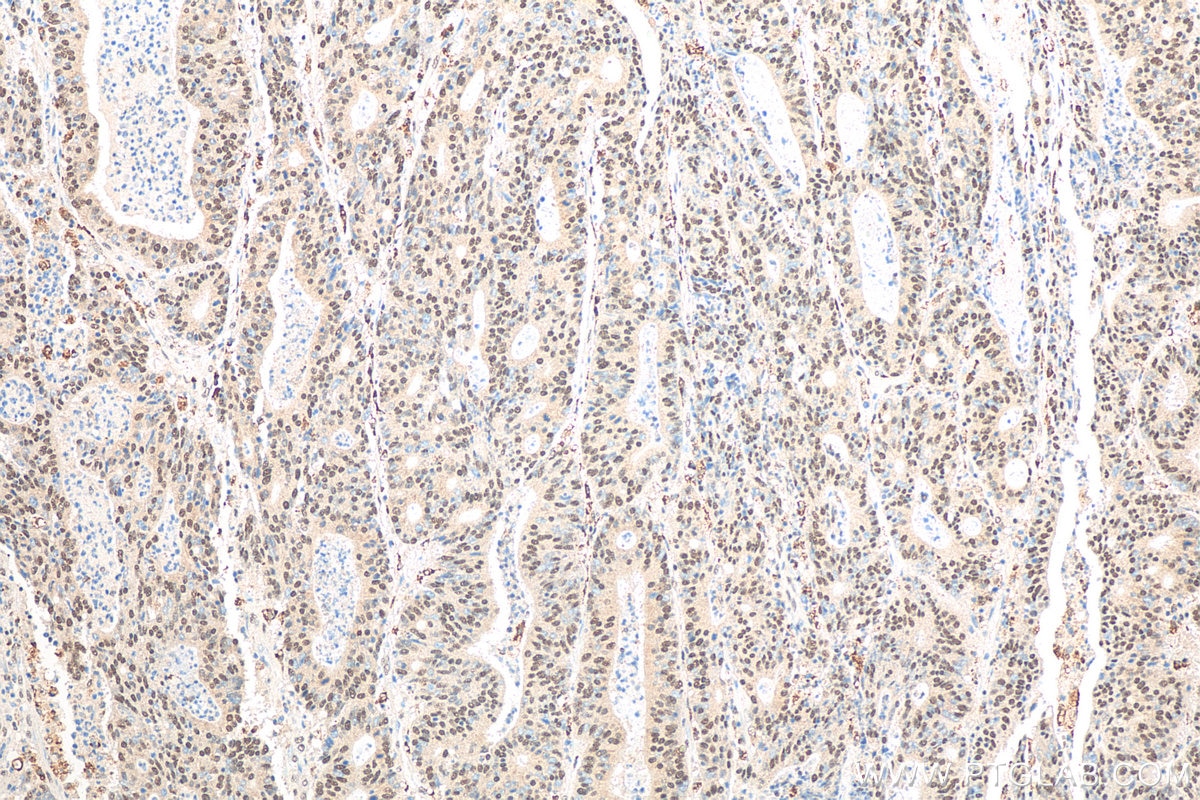 Immunohistochemistry (IHC) staining of human colon cancer tissue using EXOSC3 Polyclonal antibody (15062-1-AP)