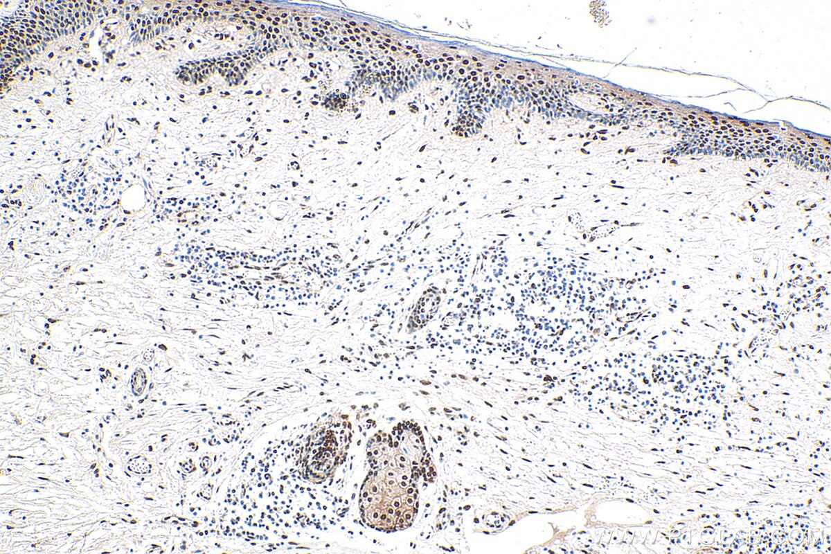 Immunohistochemistry (IHC) staining of human skin cancer tissue using EXOSC4 Polyclonal antibody (15937-1-AP)