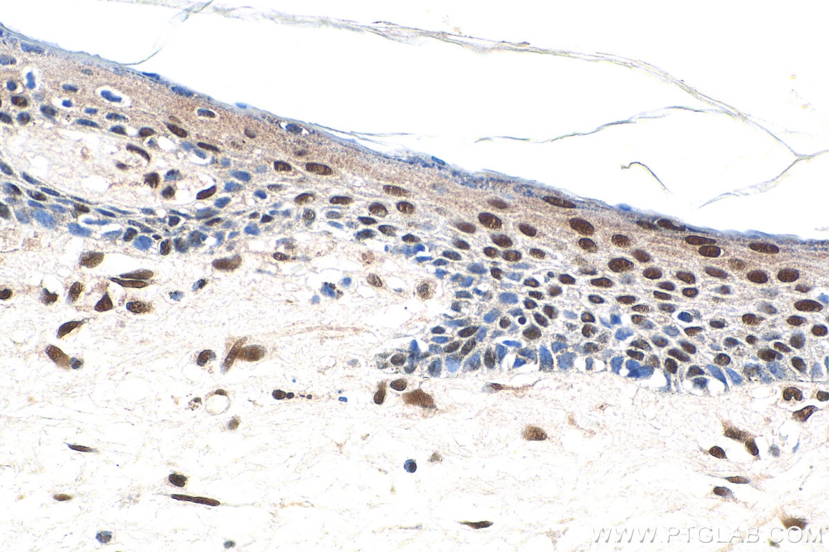 Immunohistochemistry (IHC) staining of human skin cancer tissue using EXOSC4 Polyclonal antibody (15937-1-AP)