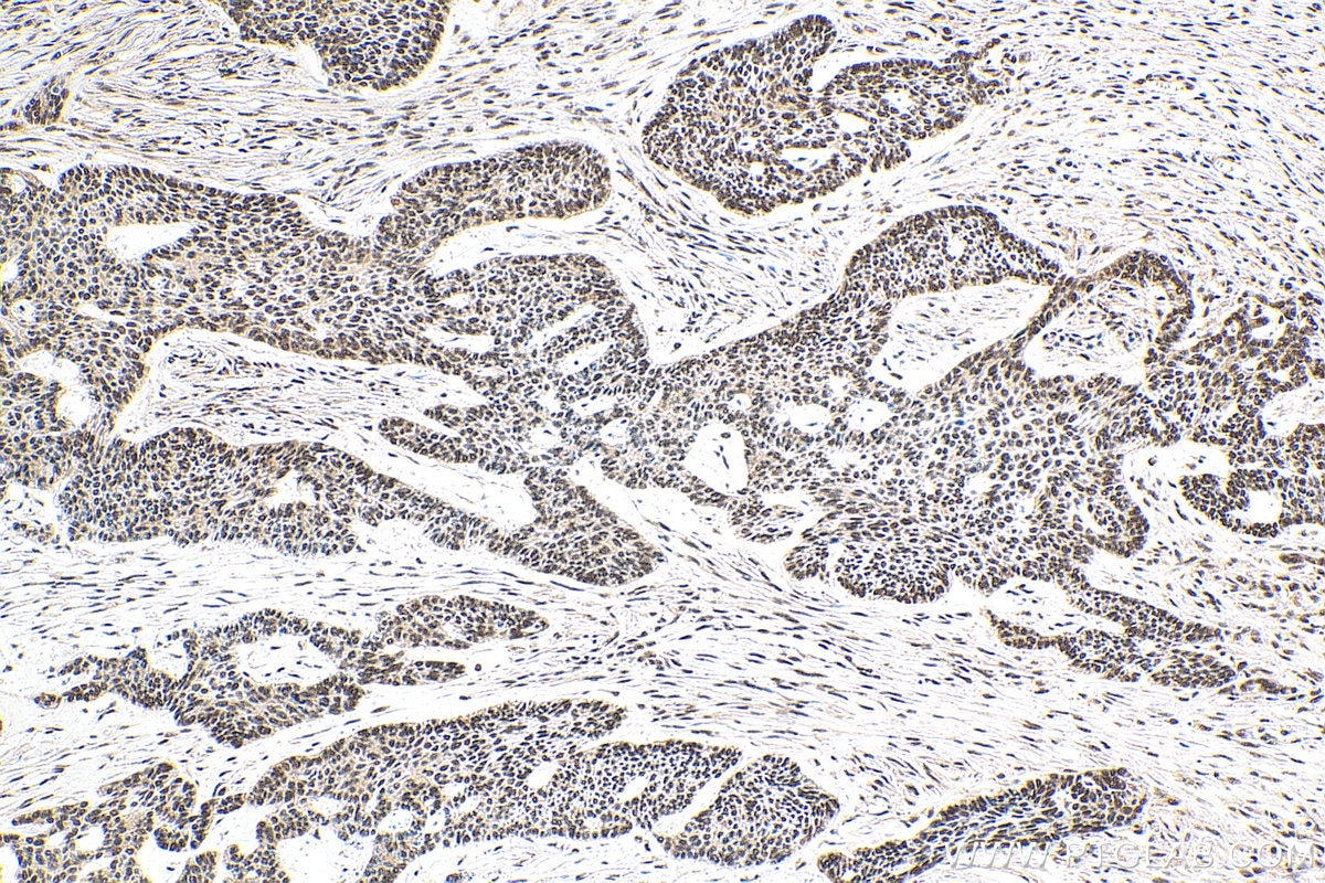 Immunohistochemistry (IHC) staining of human skin cancer tissue using EXOSC4 Polyclonal antibody (15937-1-AP)