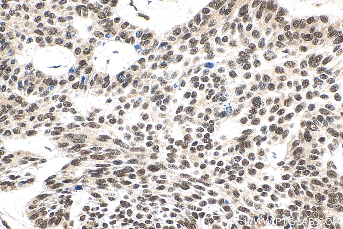 Immunohistochemistry (IHC) staining of human skin cancer tissue using EXOSC4 Polyclonal antibody (15937-1-AP)