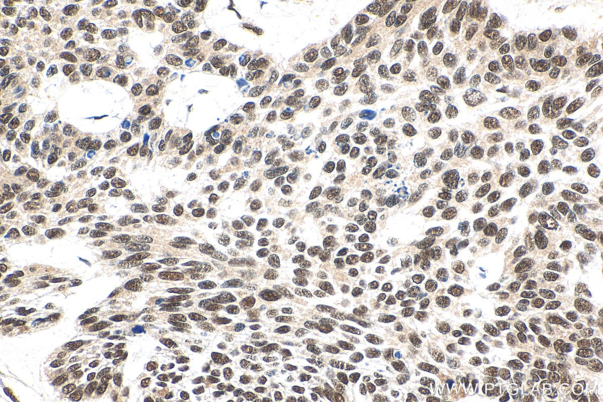 IHC staining of human skin cancer using 15937-1-AP