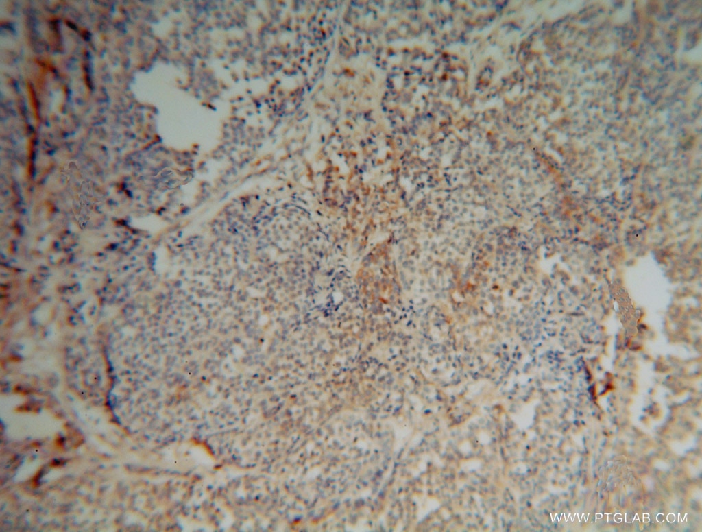 Immunohistochemistry (IHC) staining of human breast cancer tissue using EXOSC5 Polyclonal antibody (15627-1-AP)