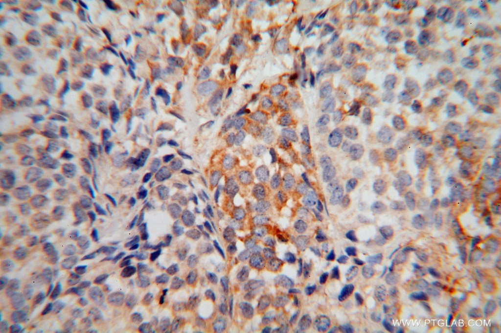 Immunohistochemistry (IHC) staining of human breast cancer tissue using EXOSC5 Polyclonal antibody (15627-1-AP)