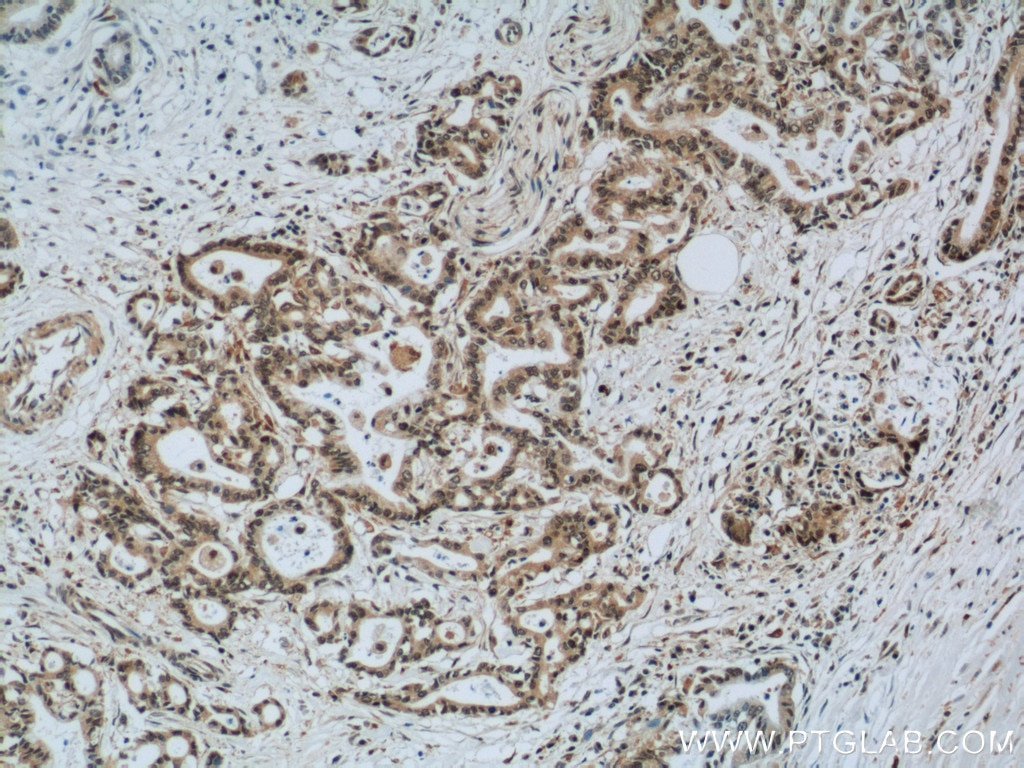 Immunohistochemistry (IHC) staining of human pancreas cancer tissue using EXOSC8 Polyclonal antibody (11979-1-AP)