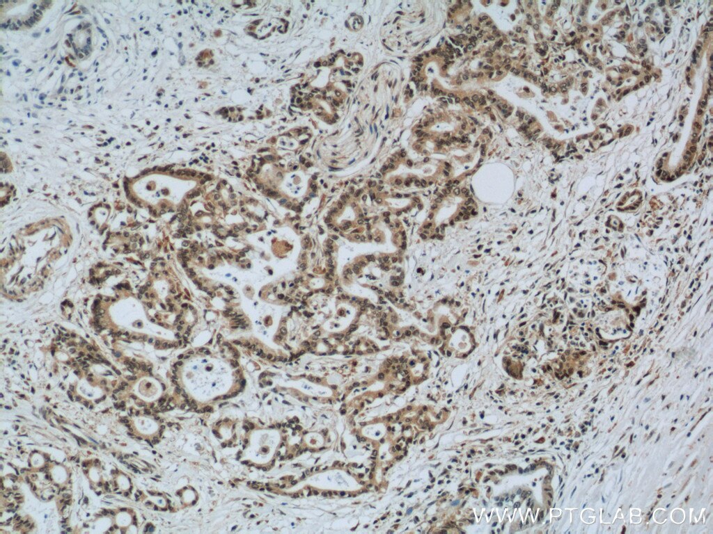 IHC staining of human pancreas cancer using 11979-1-AP