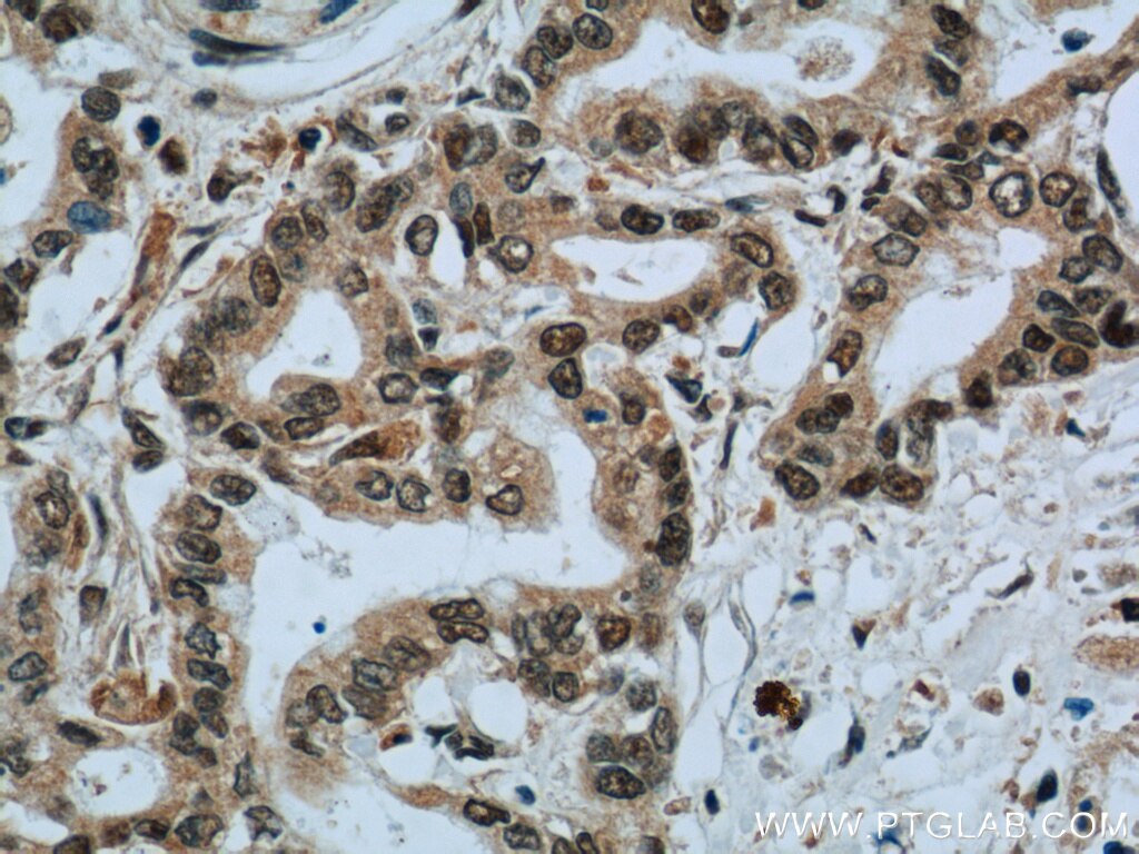 Immunohistochemistry (IHC) staining of human pancreas cancer tissue using EXOSC8 Polyclonal antibody (11979-1-AP)