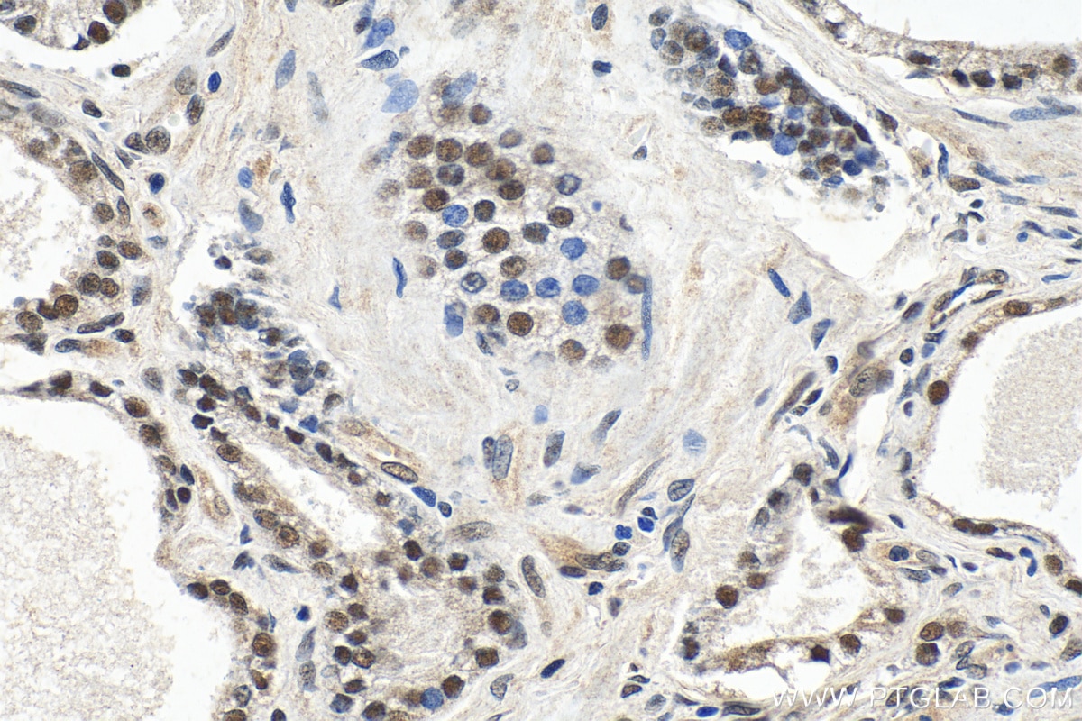 Immunohistochemistry (IHC) staining of human prostate hyperplasia tissue using EXOSC9 Polyclonal antibody (24470-1-AP)