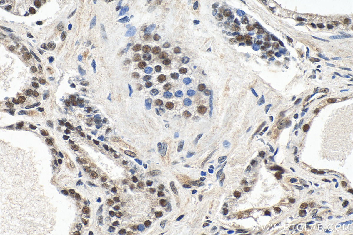 IHC staining of human prostate hyperplasia using 24470-1-AP