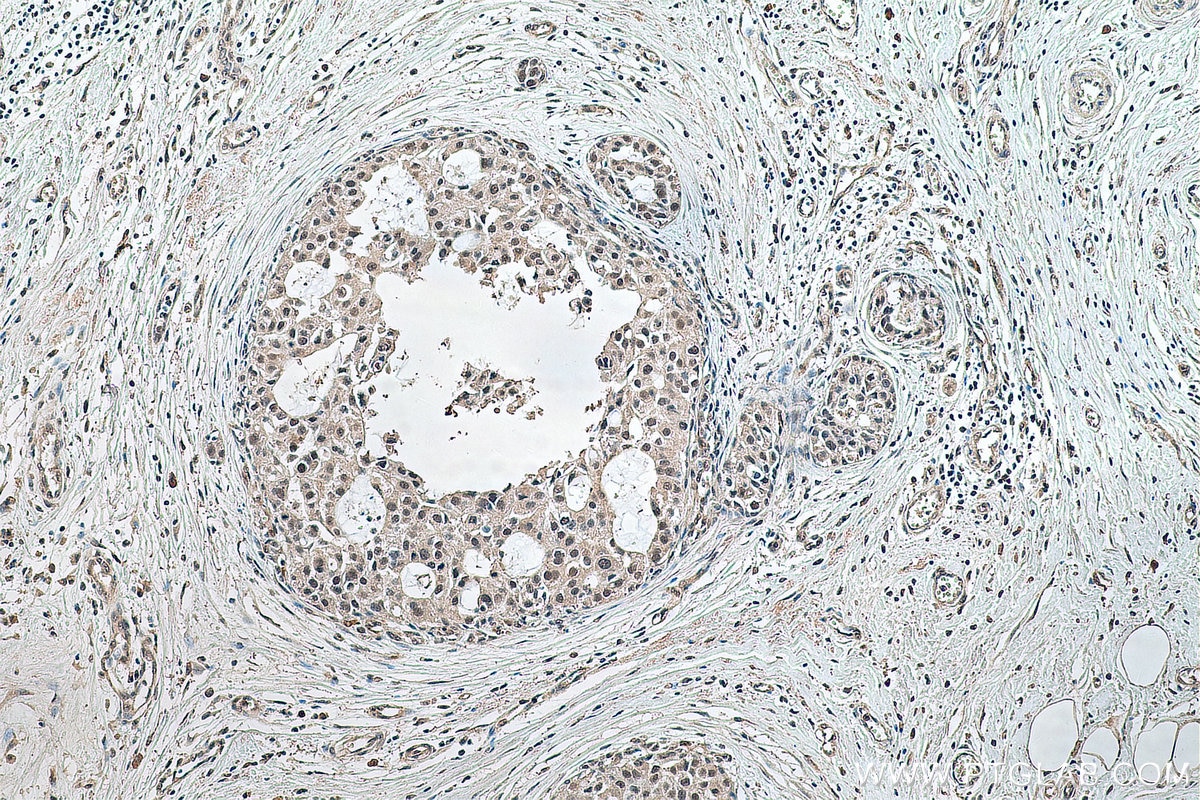 Immunohistochemistry (IHC) staining of human breast cancer tissue using EXOSC9 Monoclonal antibody (67636-1-Ig)