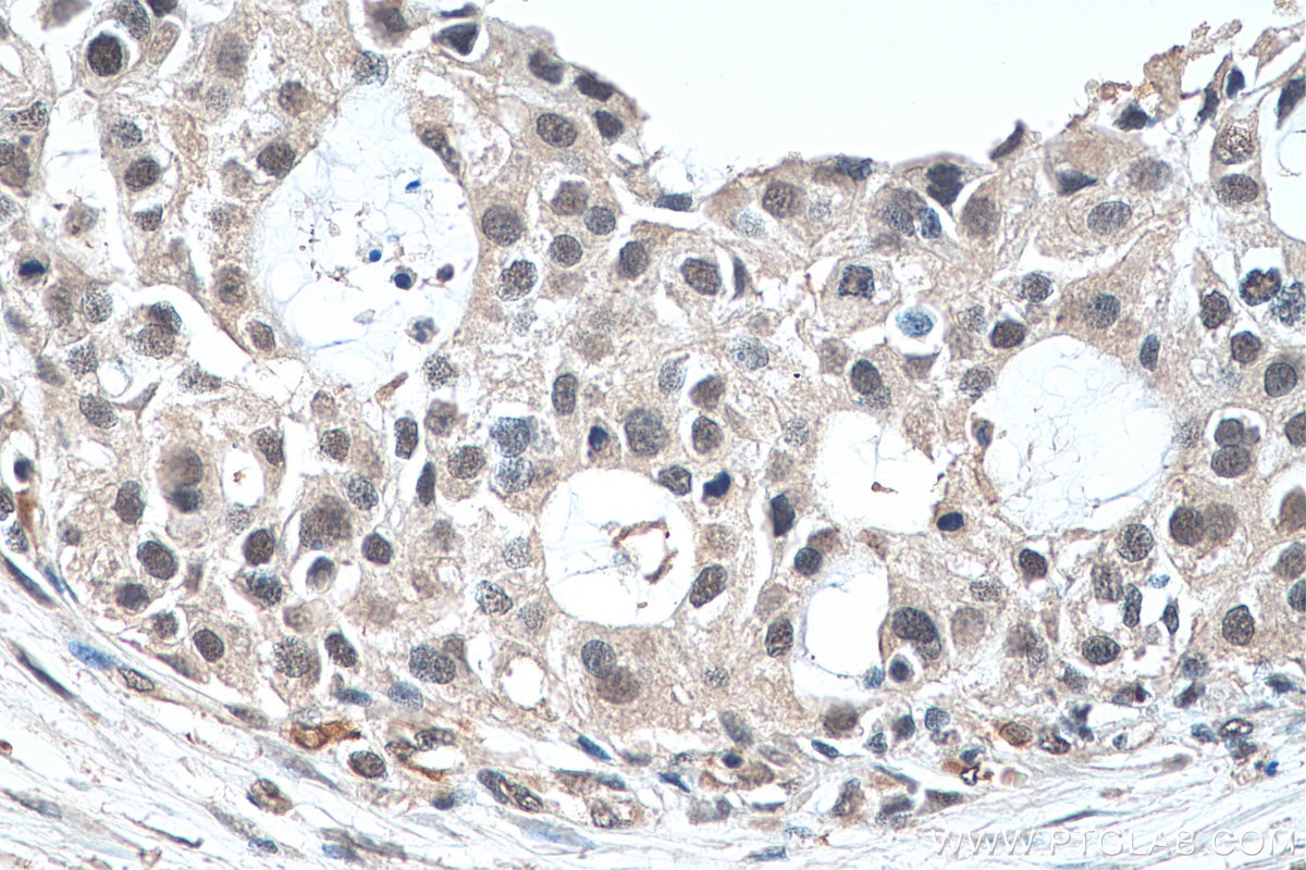 IHC staining of human breast cancer using 67636-1-Ig