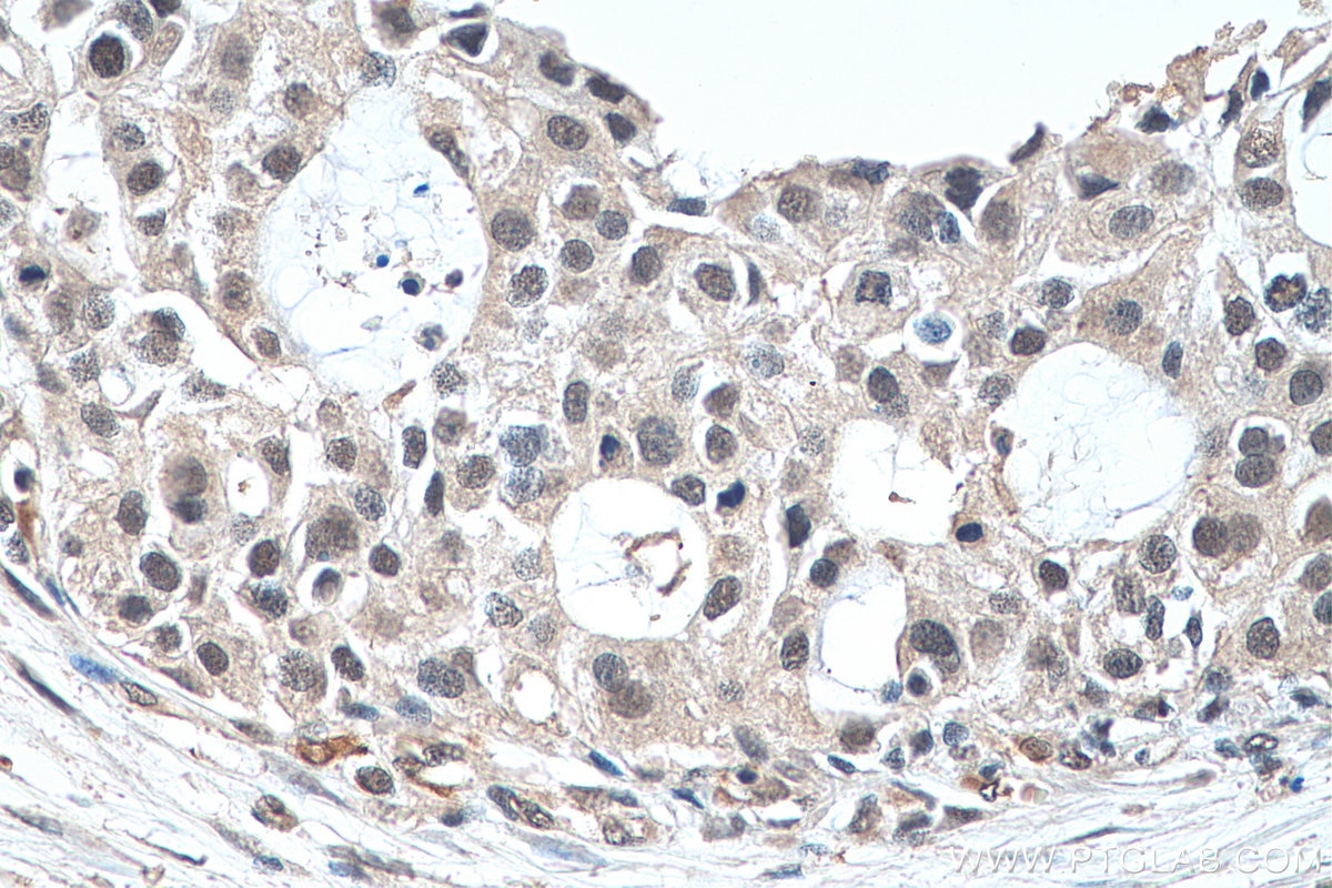 Immunohistochemistry (IHC) staining of human breast cancer tissue using EXOSC9 Monoclonal antibody (67636-1-Ig)