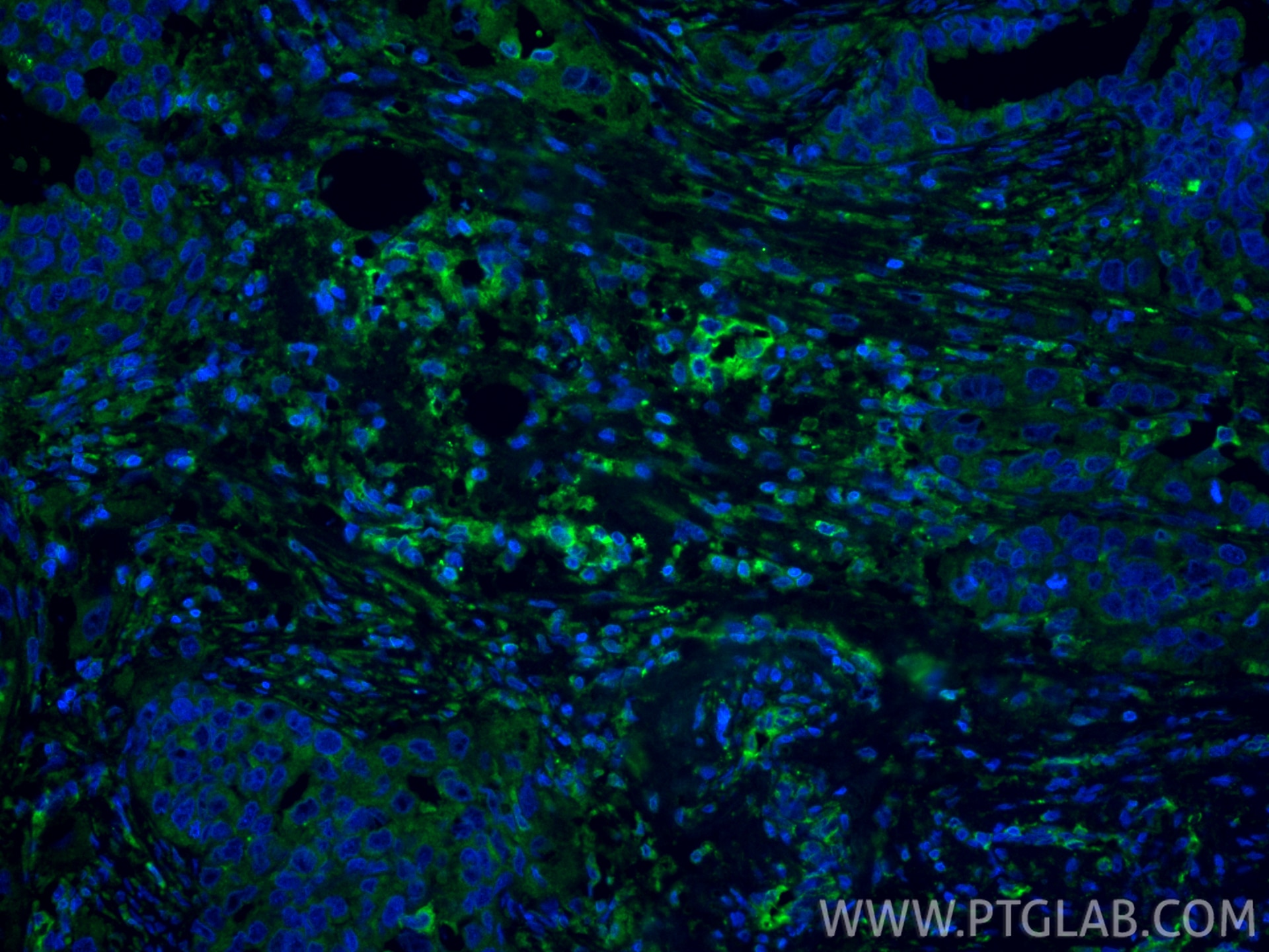 Immunofluorescent analysis of (4% PFA) fixed paraffin-embedded human colon cancer tissue using EXT2 antibody (11348-1-AP) at dilution of 1:400 and CoraLite®488-Conjugated Goat Anti-Rabbit IgG(H+L) (SA00013-2). Heat mediated antigen retrieval with Tris-EDTA buffer (pH 9.0). Immunofluorescence (IF) / fluorescent staining of human colon cancer tissue using EXT2 Polyclonal antibody (11348-1-AP)