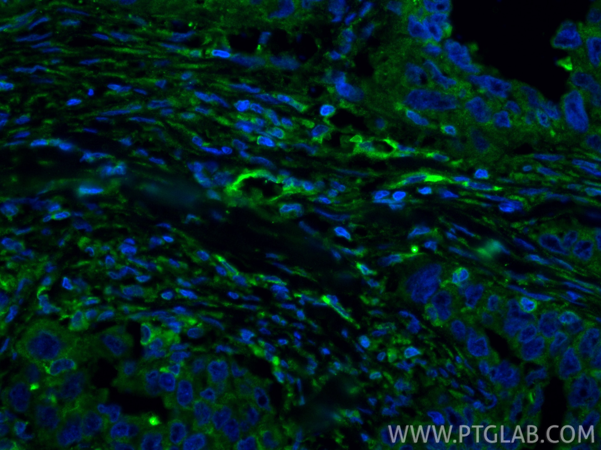 Immunofluorescent analysis of (4% PFA) fixed paraffin-embedded human colon cancer tissue using EXT2 antibody (11348-1-AP) at dilution of 1:400 and CoraLite®488-Conjugated Goat Anti-Rabbit IgG(H+L) (SA00013-2). Heat mediated antigen retrieval with Tris-EDTA buffer (pH 9.0). Immunofluorescence (IF) / fluorescent staining of human colon cancer tissue using EXT2 Polyclonal antibody (11348-1-AP)