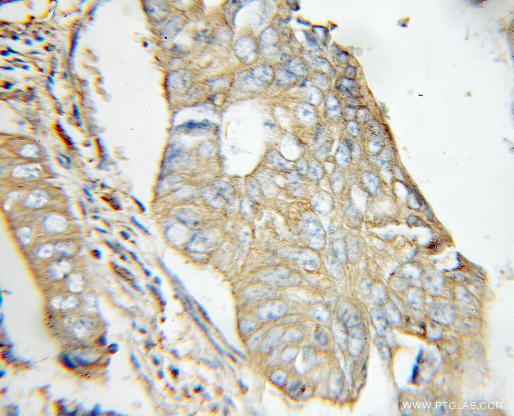 Immunohistochemistry (IHC) staining of human colon cancer tissue using EXT2 Polyclonal antibody (11348-1-AP)