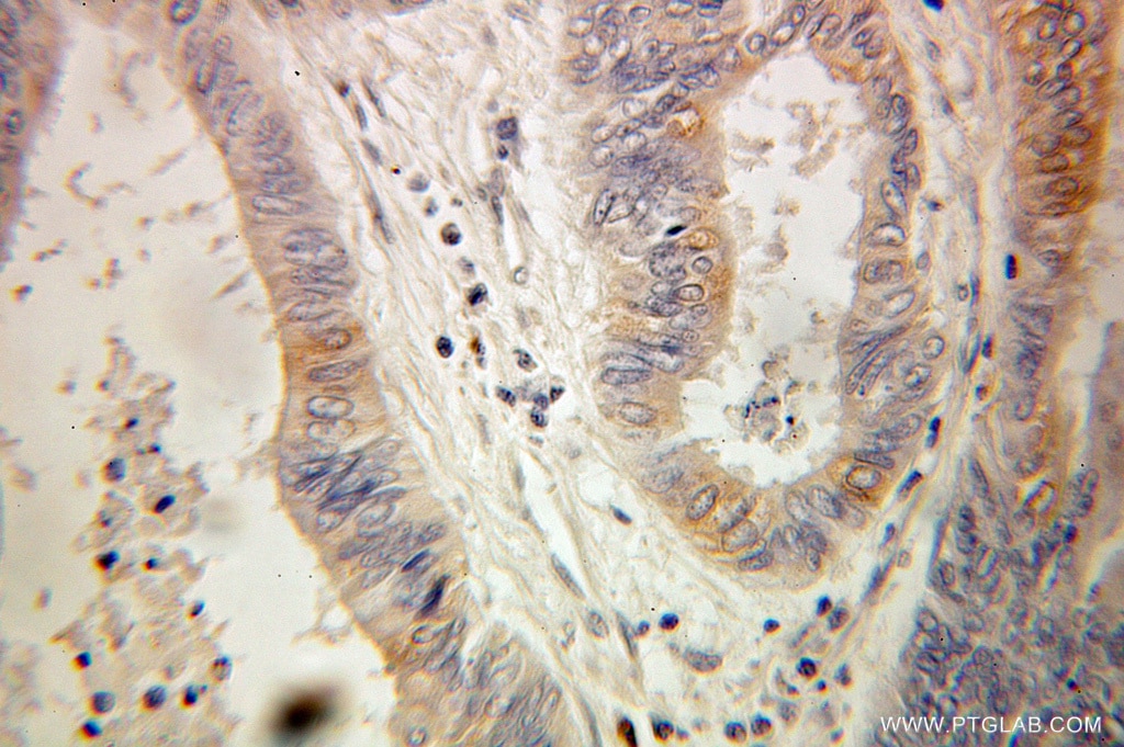 Immunohistochemistry (IHC) staining of human colon cancer tissue using EXTL3 Polyclonal antibody (10588-1-AP)