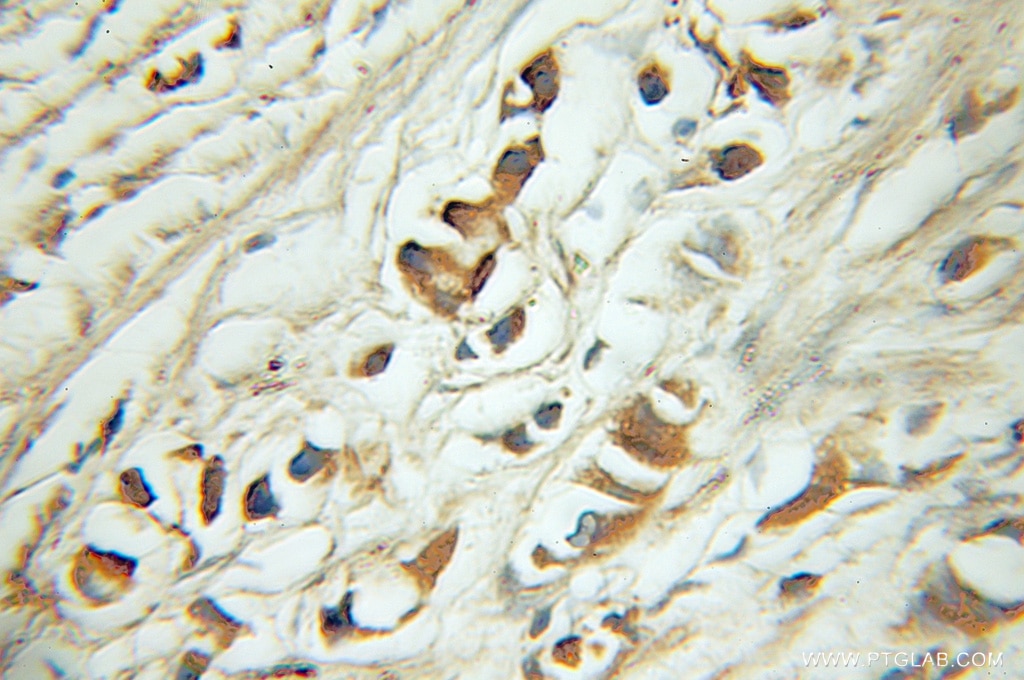 Immunohistochemistry (IHC) staining of human prostate cancer tissue using EYA2 Polyclonal antibody (11314-1-AP)