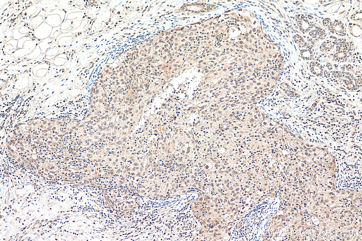IHC staining of human breast cancer using 21196-1-AP