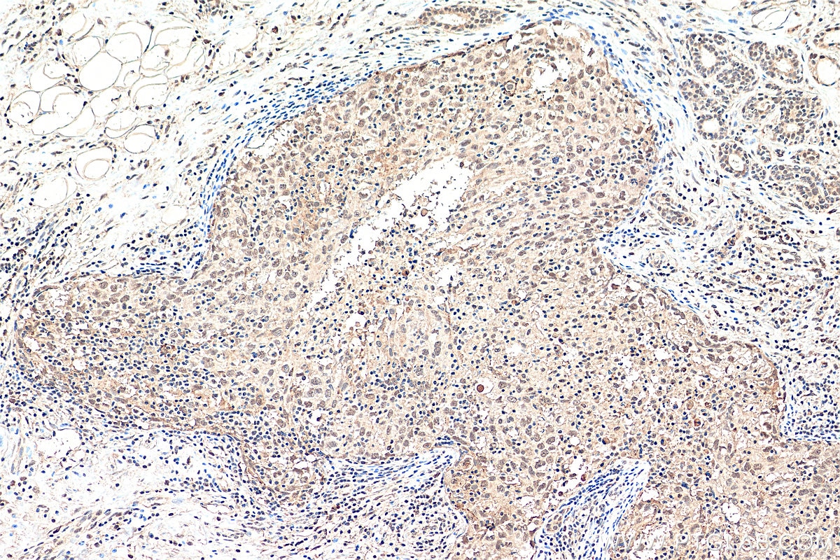 Immunohistochemistry (IHC) staining of human breast cancer tissue using EYA3 Polyclonal antibody (21196-1-AP)