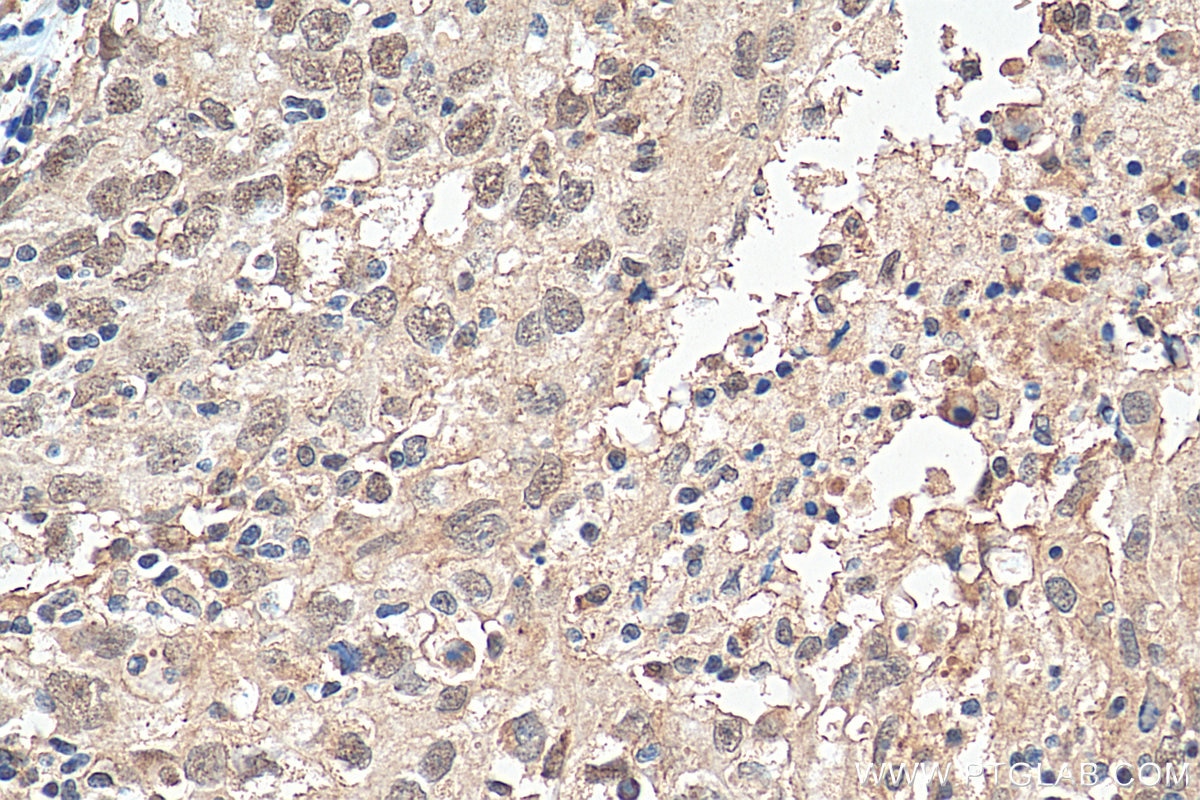 Immunohistochemistry (IHC) staining of human breast cancer tissue using EYA3 Polyclonal antibody (21196-1-AP)