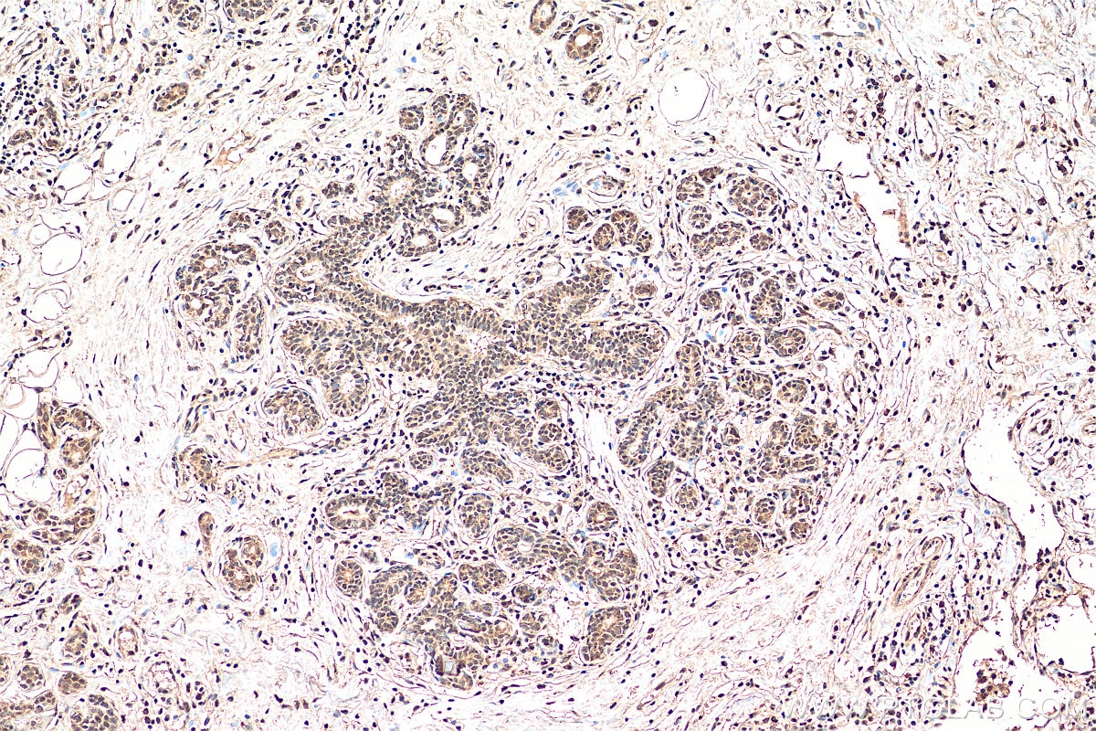 Immunohistochemistry (IHC) staining of human breast cancer tissue using EYA3 Polyclonal antibody (21196-1-AP)