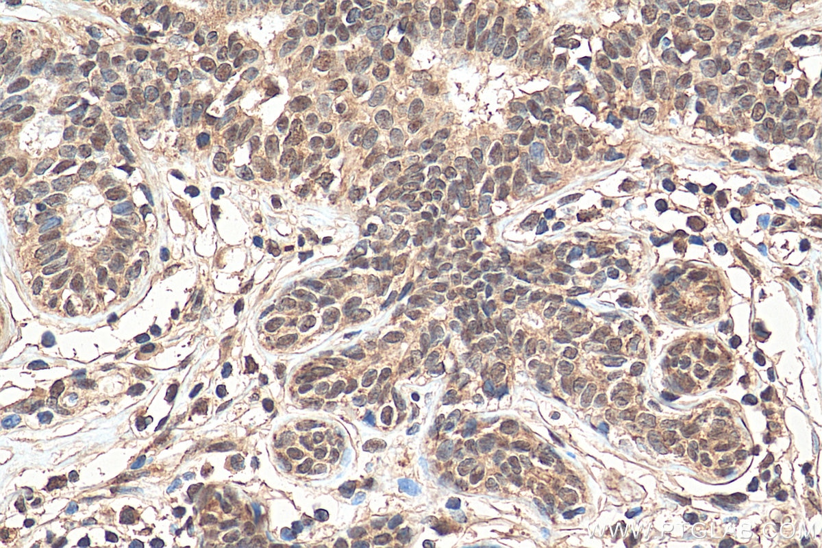 Immunohistochemistry (IHC) staining of human breast cancer tissue using EYA3 Polyclonal antibody (21196-1-AP)