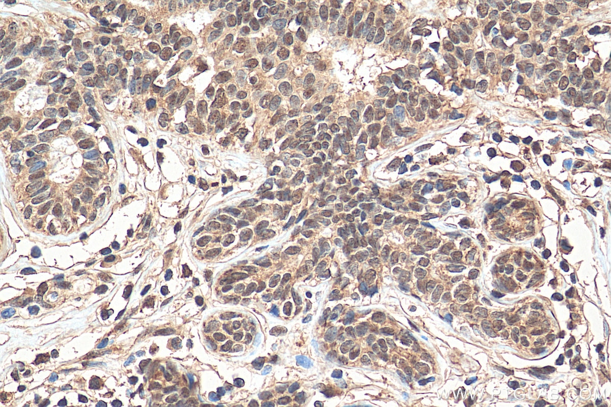 IHC staining of human breast cancer using 21196-1-AP