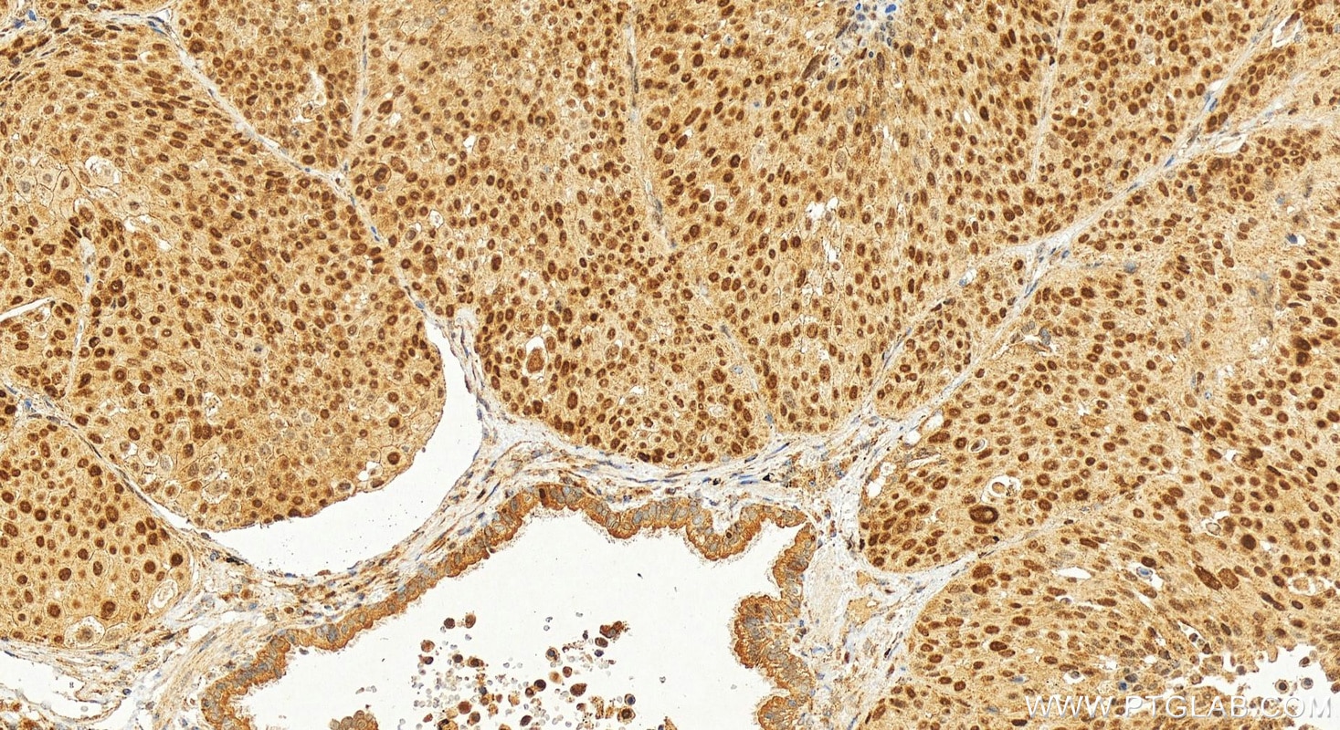 Immunohistochemistry (IHC) staining of human lung squamous cell carcinoma tissue using EZH2 Polyclonal antibody (21800-1-AP)
