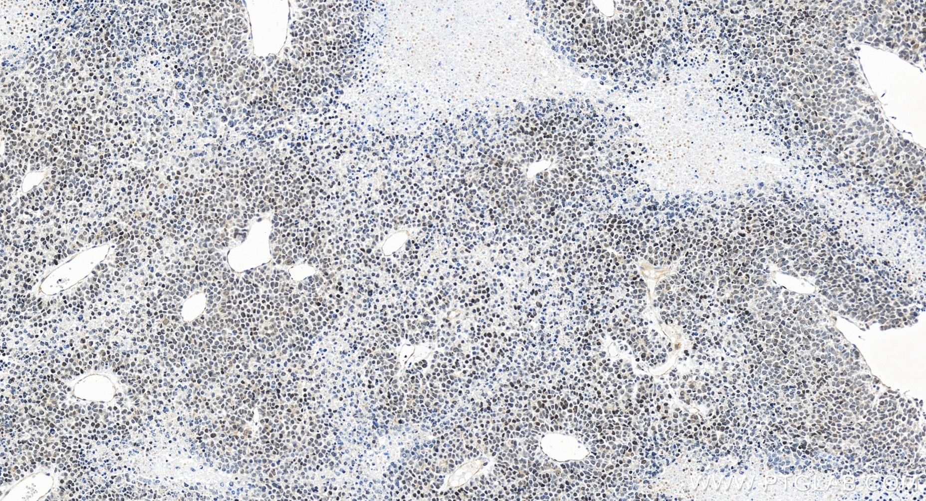 Immunohistochemistry (IHC) staining of human liver cancer tissue using EZH2 Recombinant antibody (84824-2-RR)