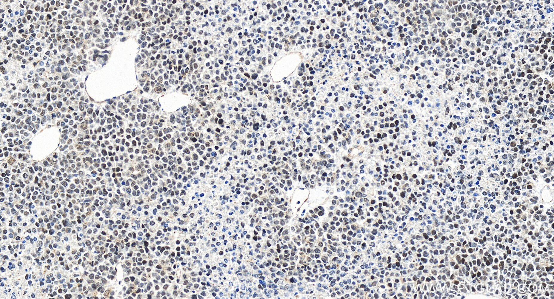 Immunohistochemistry (IHC) staining of human liver cancer tissue using EZH2 Recombinant antibody (84824-2-RR)