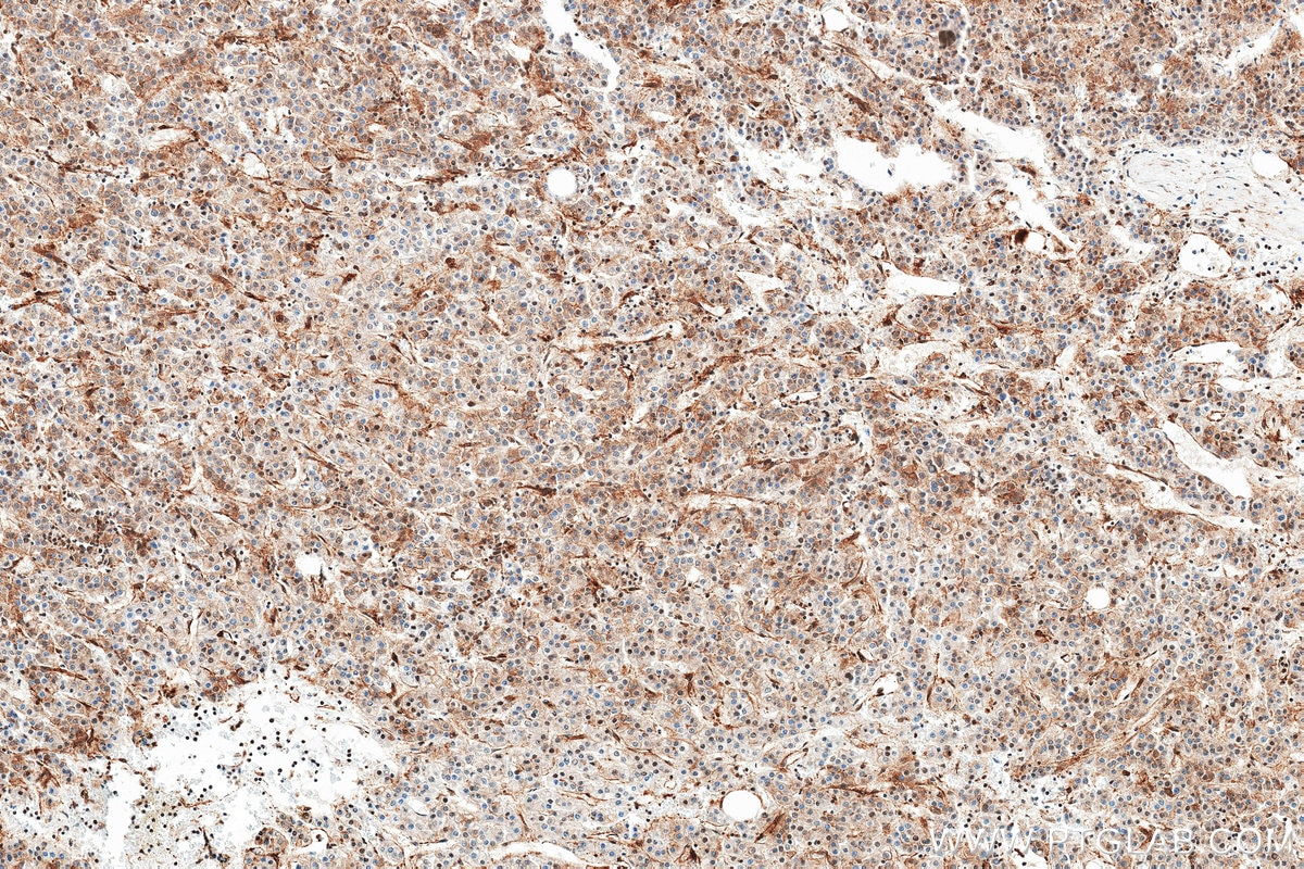 Immunohistochemistry (IHC) staining of Human Hepatocellular cancer using EZH2 Recombinant monoclonal antibody (84824-2-RR)