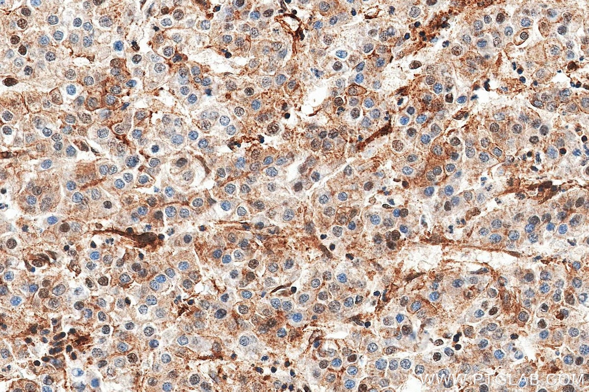 Immunohistochemistry (IHC) staining of Human Hepatocellular cancer using EZH2 Recombinant monoclonal antibody (84824-2-RR)
