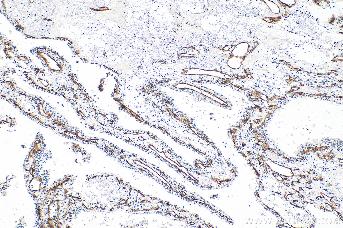 IHC staining of human renal cell carcinoma using 30730-1-AP