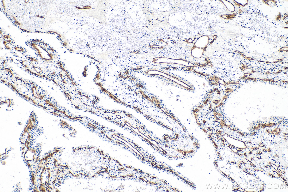 Immunohistochemistry (IHC) staining of human renal cell carcinoma tissue using Endoglin/CD105 Polyclonal antibody (30730-1-AP)