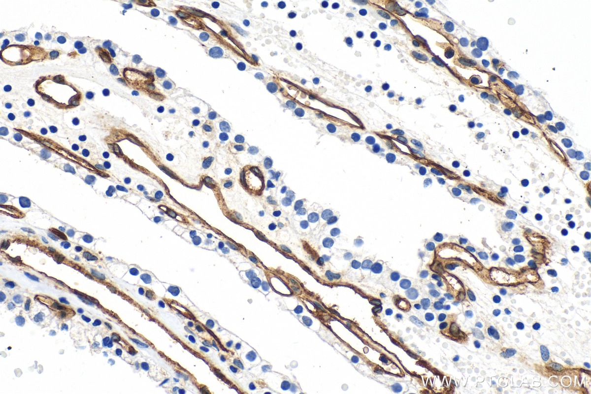 Immunohistochemistry (IHC) staining of human renal cell carcinoma tissue using Endoglin/CD105 Polyclonal antibody (30730-1-AP)