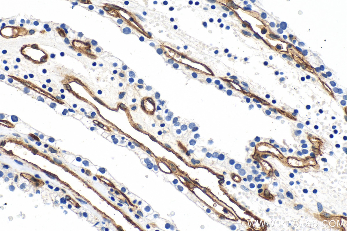 IHC staining of human renal cell carcinoma using 30730-1-AP