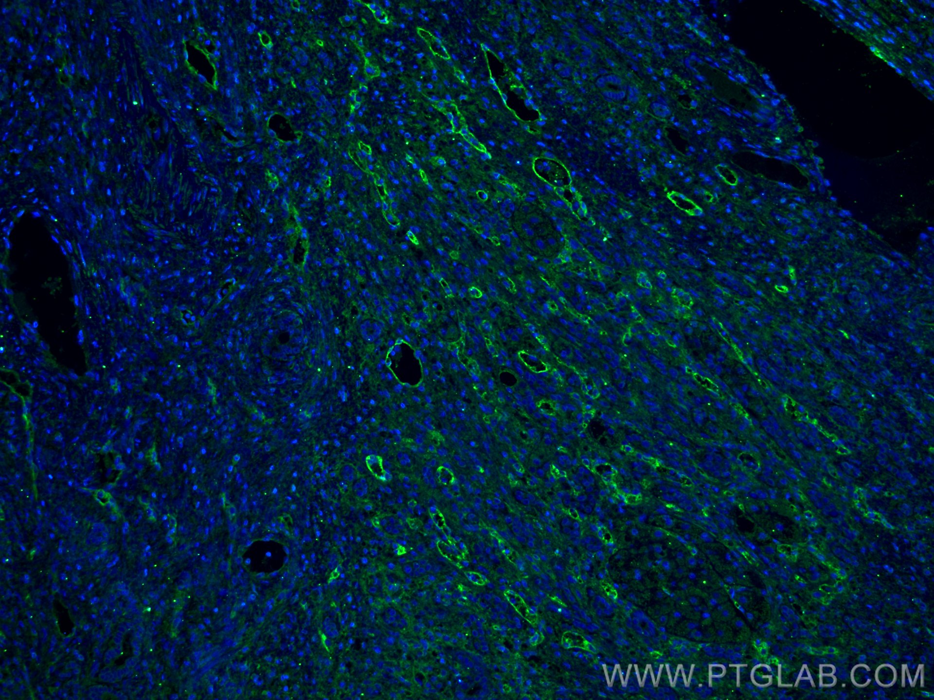 Immunofluorescence (IF) / fluorescent staining of human liver cancer tissue using Endoglin/CD105 Monoclonal antibody (67075-1-Ig)