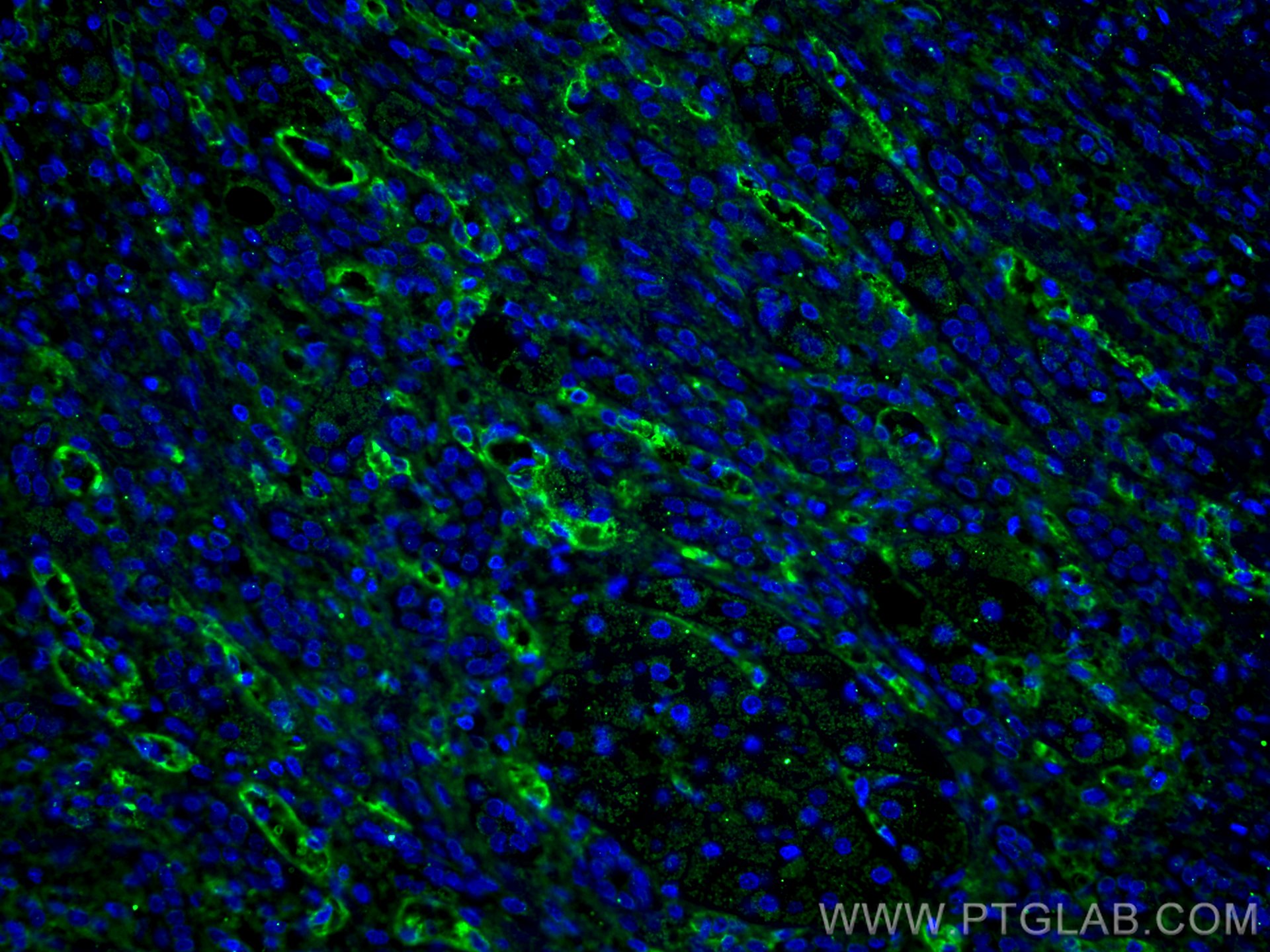 IF Staining of human liver cancer using 67075-1-Ig