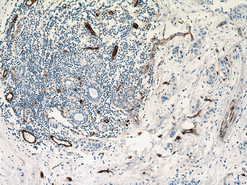 Immunohistochemistry (IHC) staining of human breast cancer tissue using Endoglin/CD105 Monoclonal antibody (67075-1-Ig)