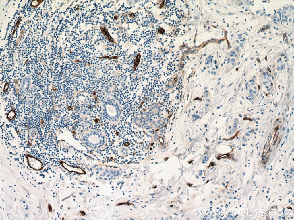 IHC staining of human breast cancer using 67075-1-Ig