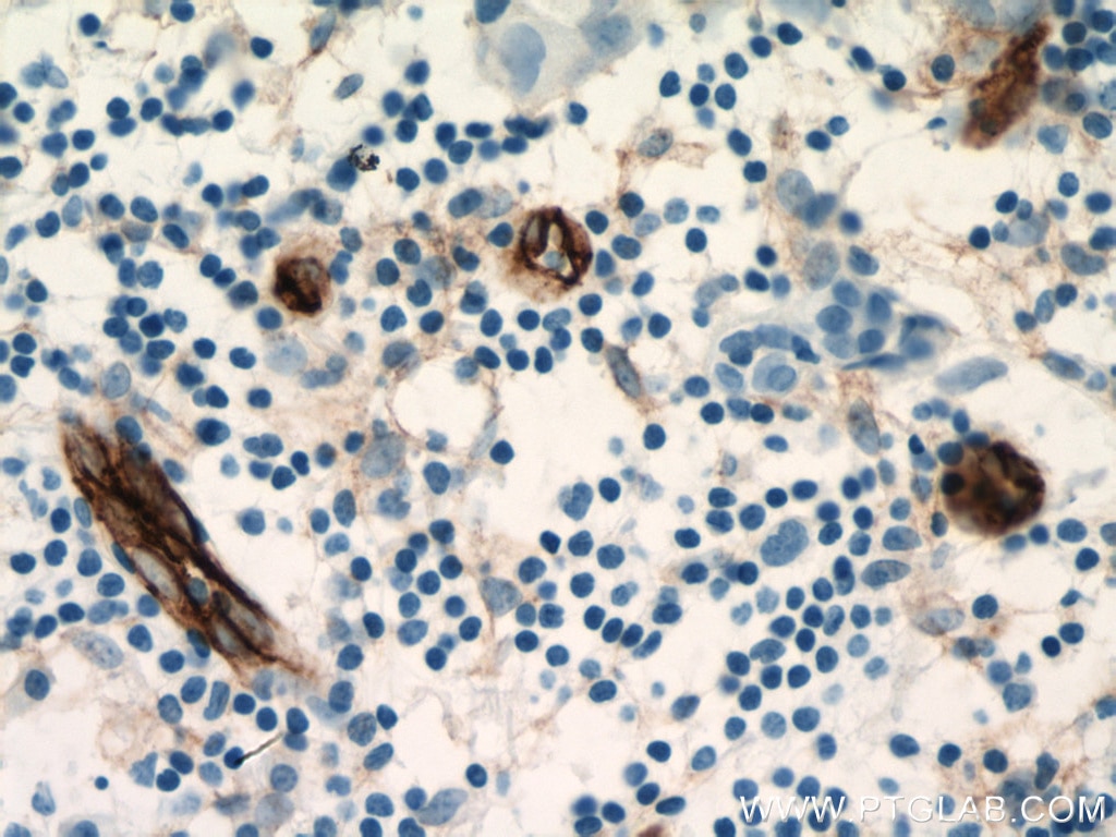 Immunohistochemistry (IHC) staining of human breast cancer tissue using Endoglin/CD105 Monoclonal antibody (67075-1-Ig)