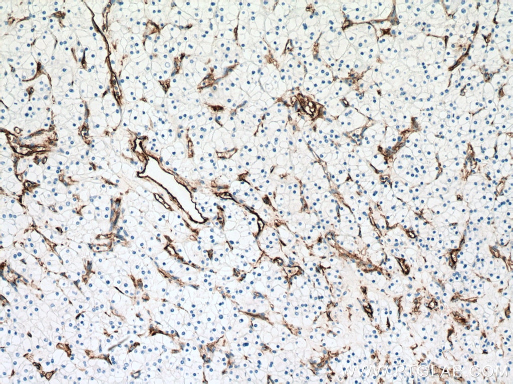 Immunohistochemistry (IHC) staining of human renal cell carcinoma tissue using Endoglin/CD105 Monoclonal antibody (67075-1-Ig)