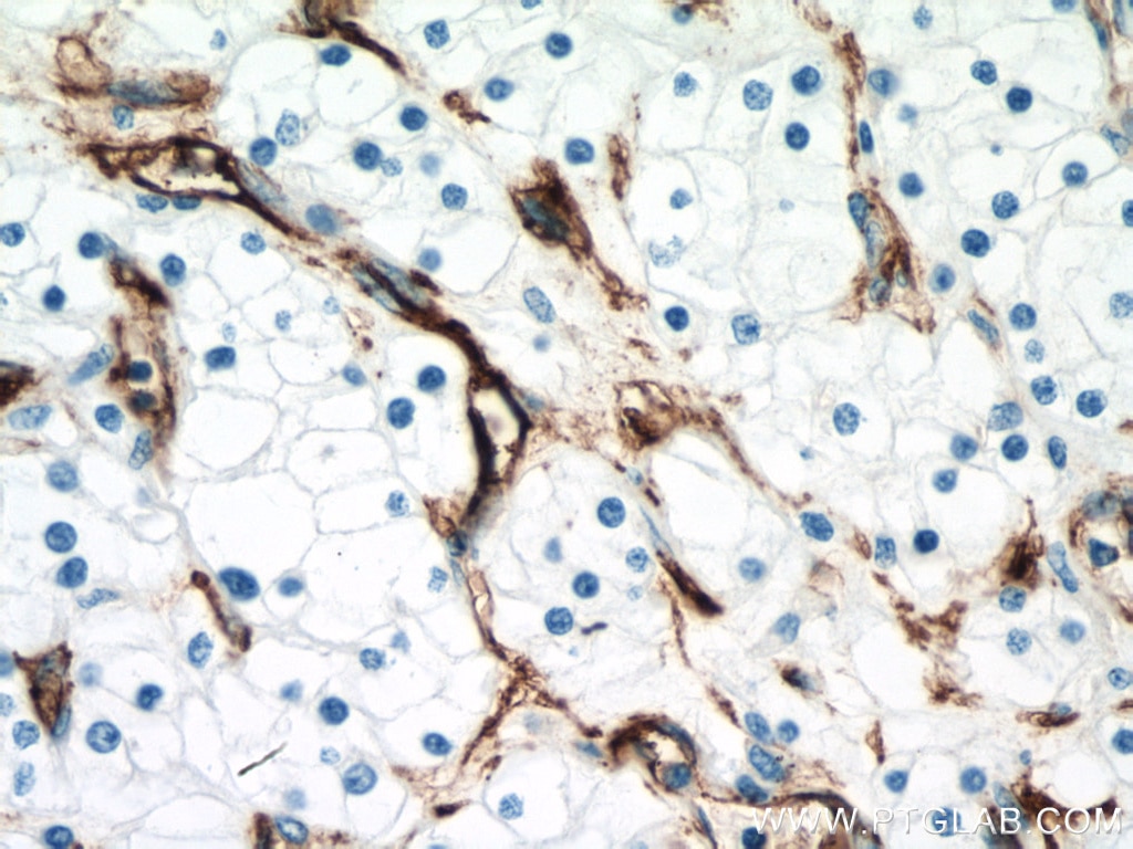 Immunohistochemistry (IHC) staining of human renal cell carcinoma tissue using Endoglin/CD105 Monoclonal antibody (67075-1-Ig)