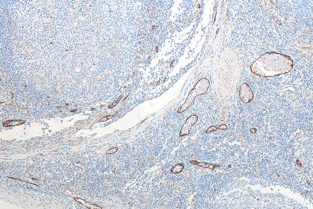 Immunohistochemistry (IHC) staining of human tonsillitis tissue using Endoglin/CD105 Monoclonal antibody (67075-1-Ig)