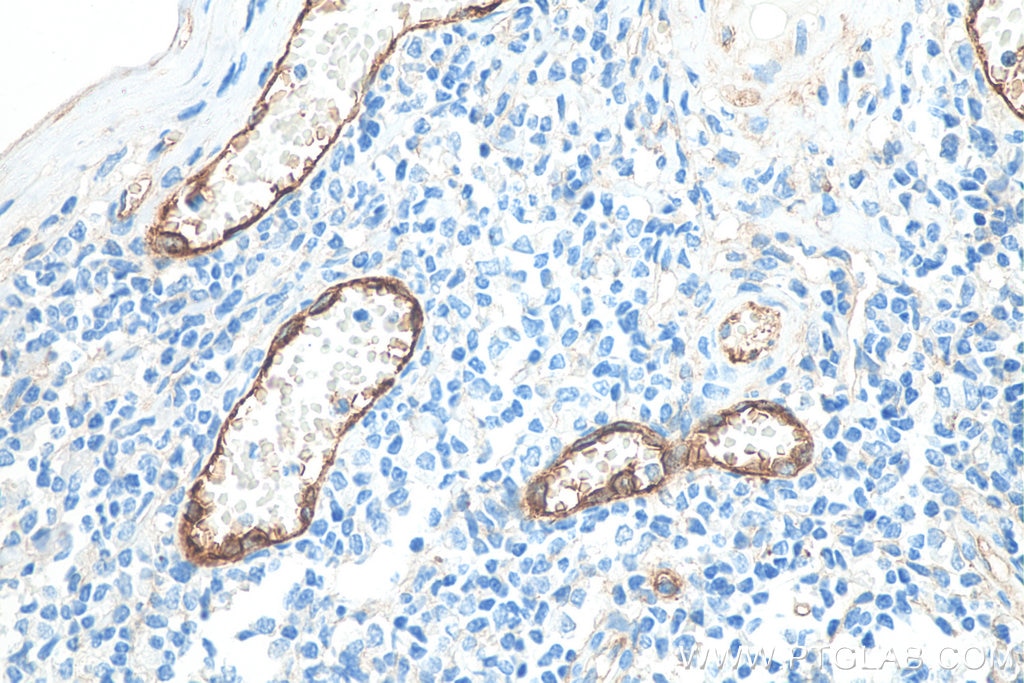Immunohistochemistry (IHC) staining of human tonsillitis tissue using Endoglin/CD105 Monoclonal antibody (67075-1-Ig)