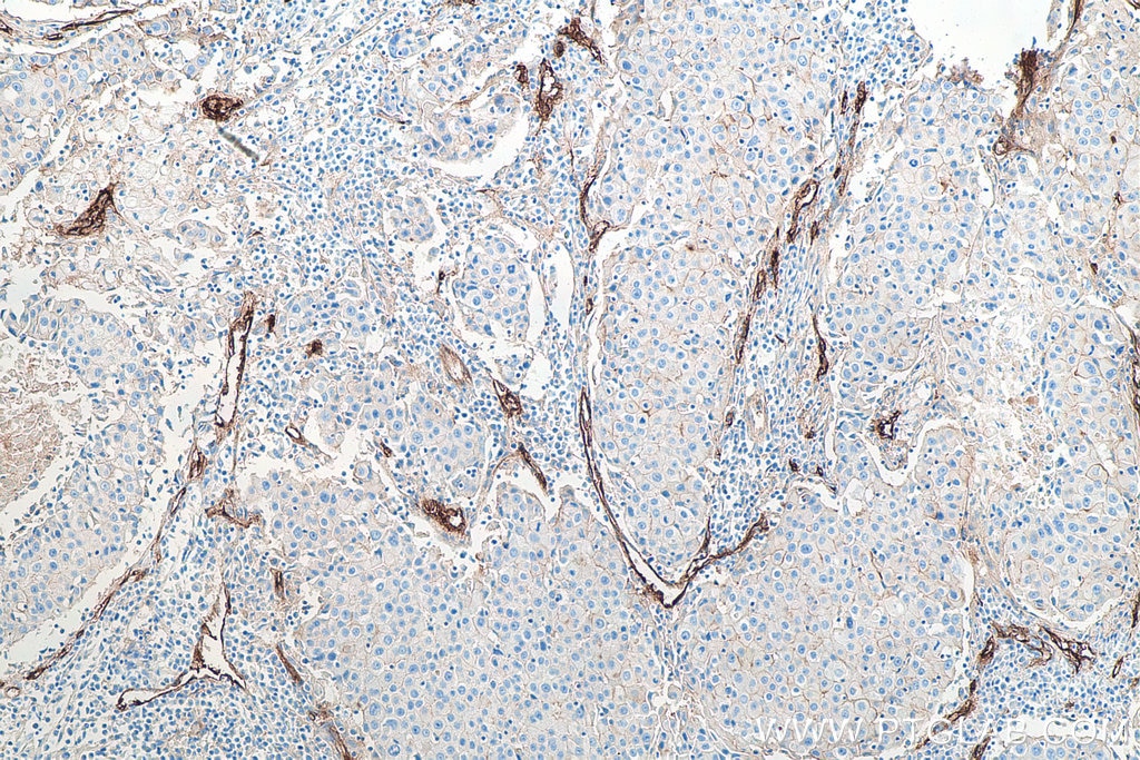 IHC staining of human breast cancer using 67075-1-Ig Immunohistochemistry (IHC) staining of human breast cancer tissue using Endoglin/CD105 Monoclonal antibody (67075-1-Ig)